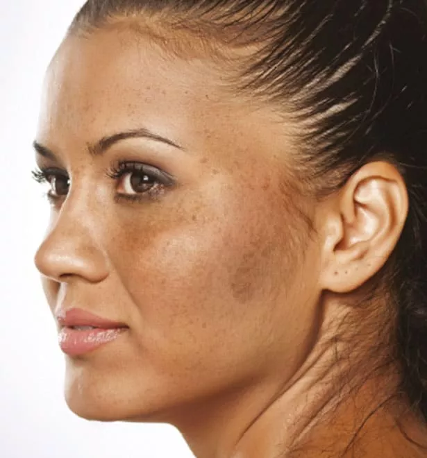 best treatment for melasma on face