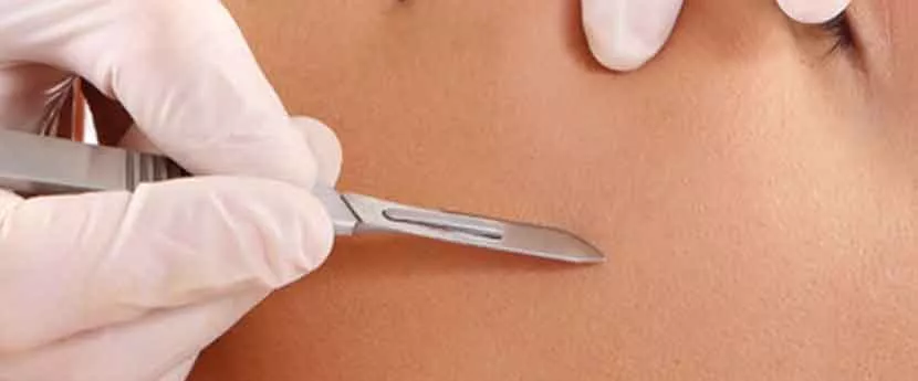 mole removal near me laser mole removal