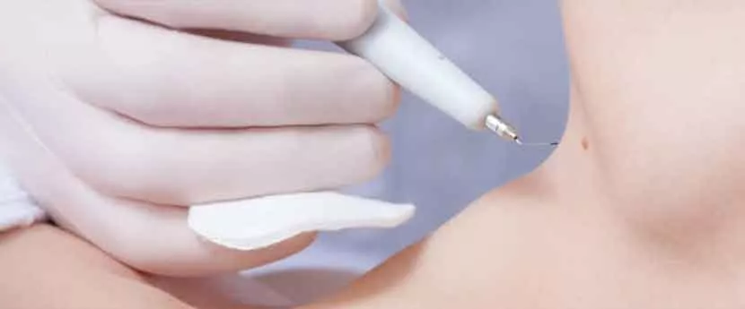 mole removal near me laser mole removal