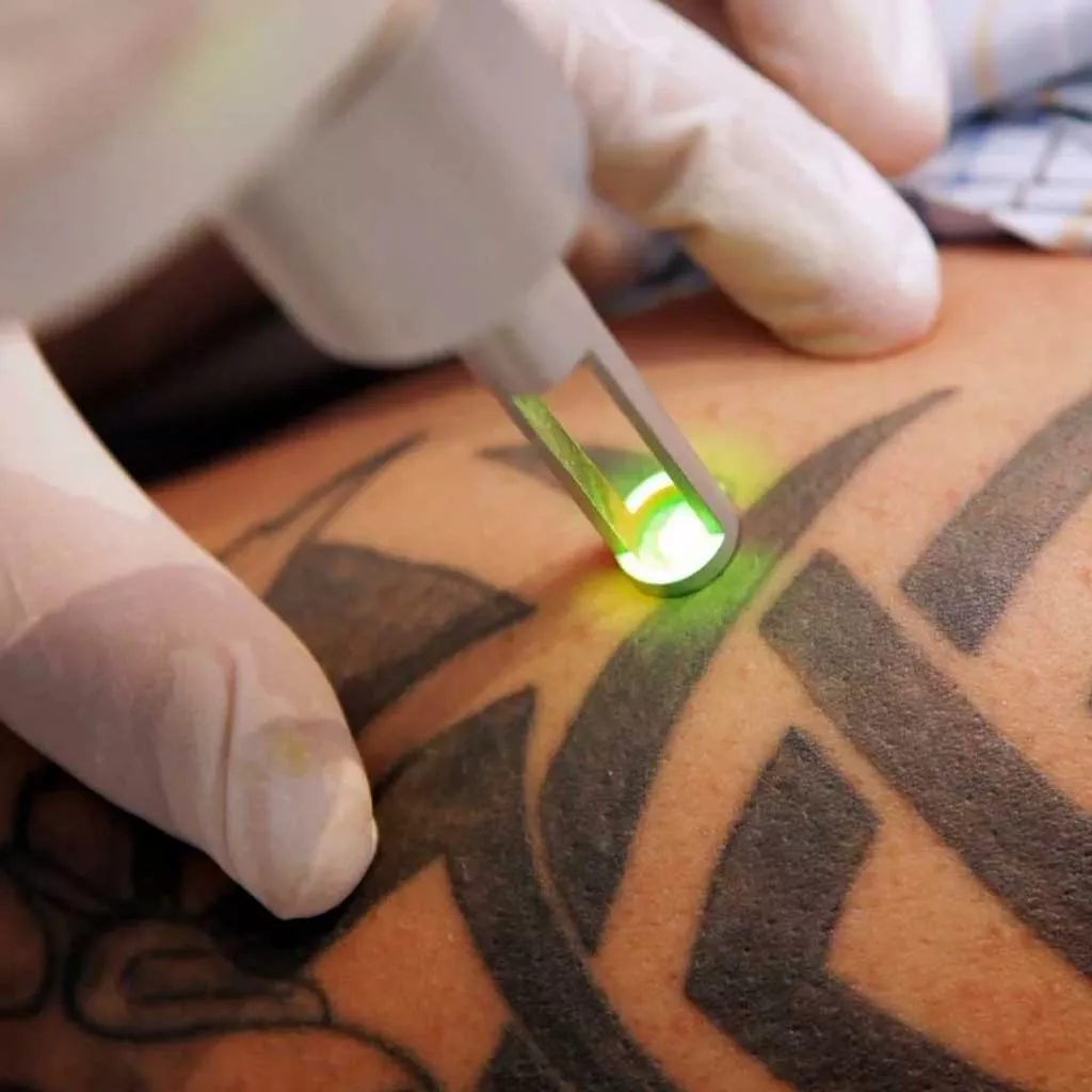 tattoo removal near me