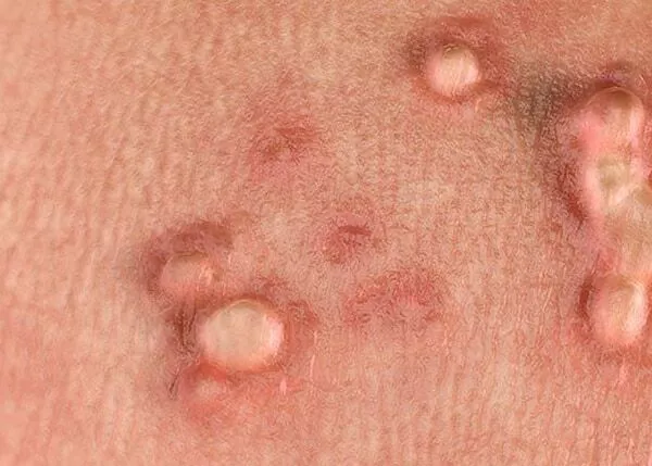 wart removal near me