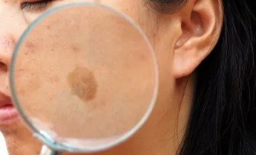 best treatment for melasma on face