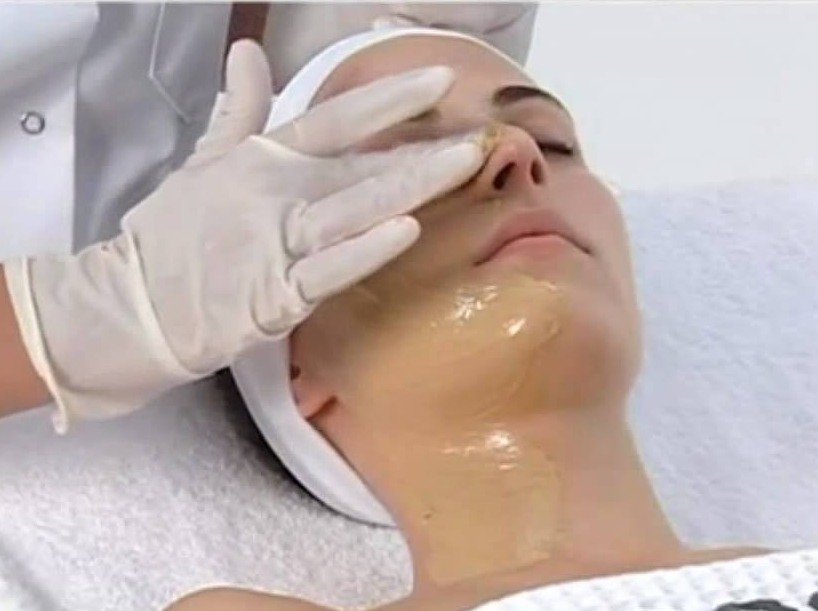 best treatment for melasma on face