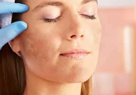 best treatment for melasma on face
