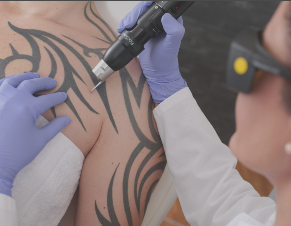 tattoo removal near me